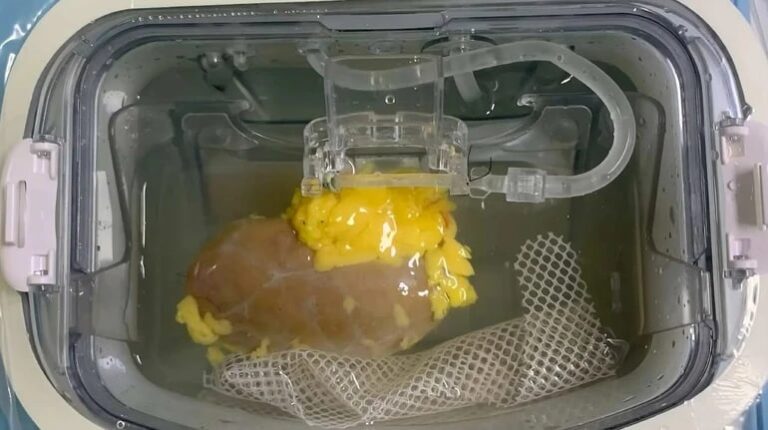 Технології - Науковці вперше створили "універсальну" нирку для трансплантації